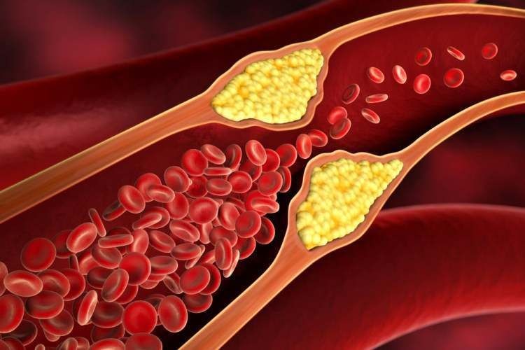  توصیه های طب اسلامی برای گرفتگی عروق و  جایگزین آنژیو بدون هیچ گونه عوارض